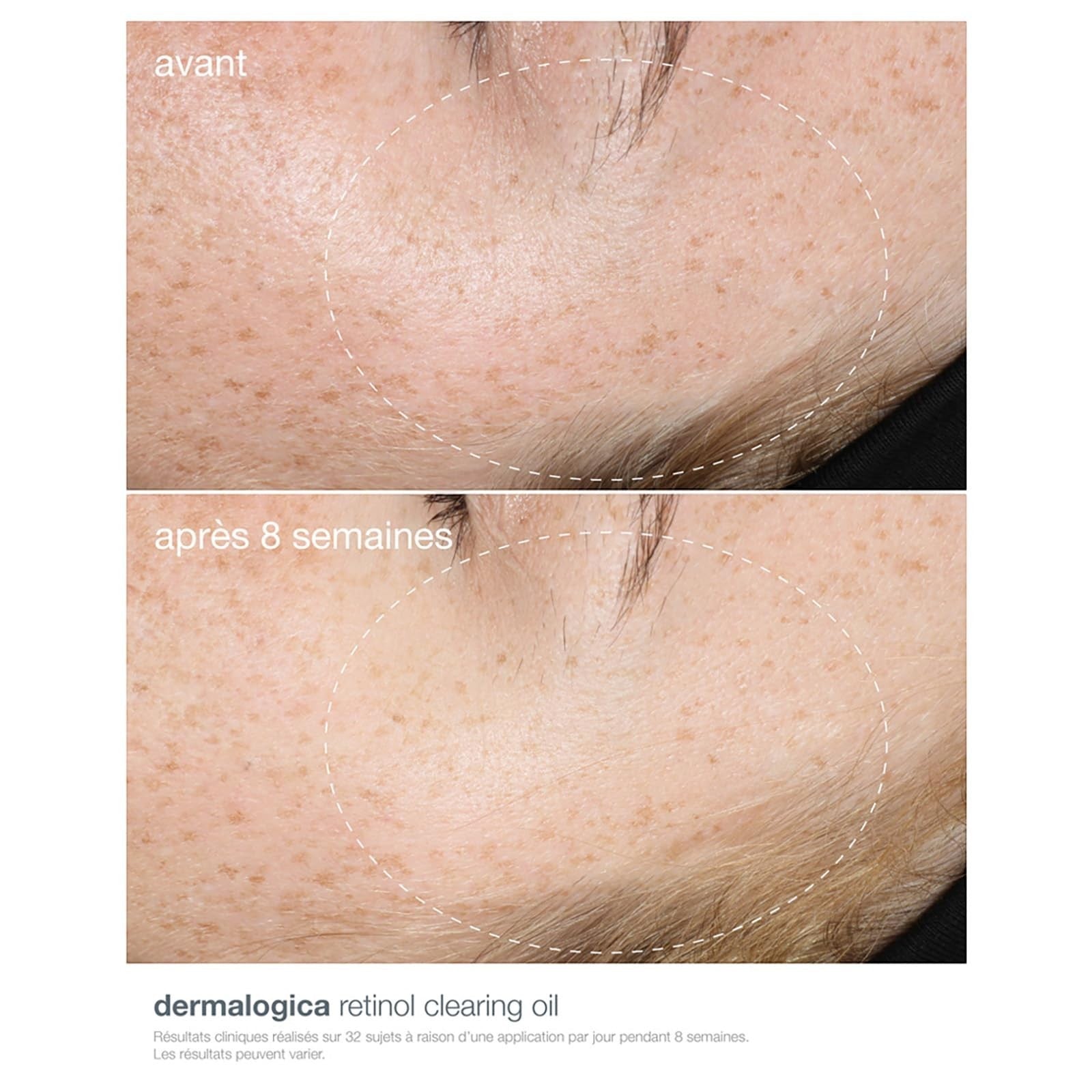 Dermalogica Retinoid Acne Clearing Oil Treatment